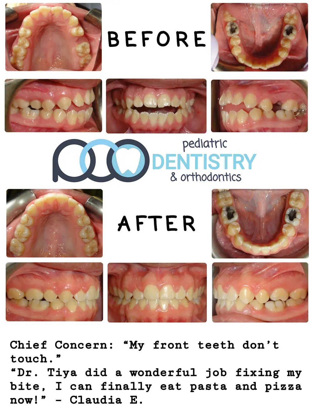 Before and After Teeth Treatment