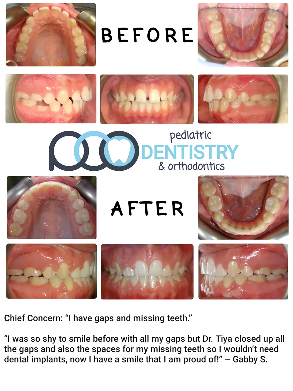 Before and After Gaps and Missing Teeth