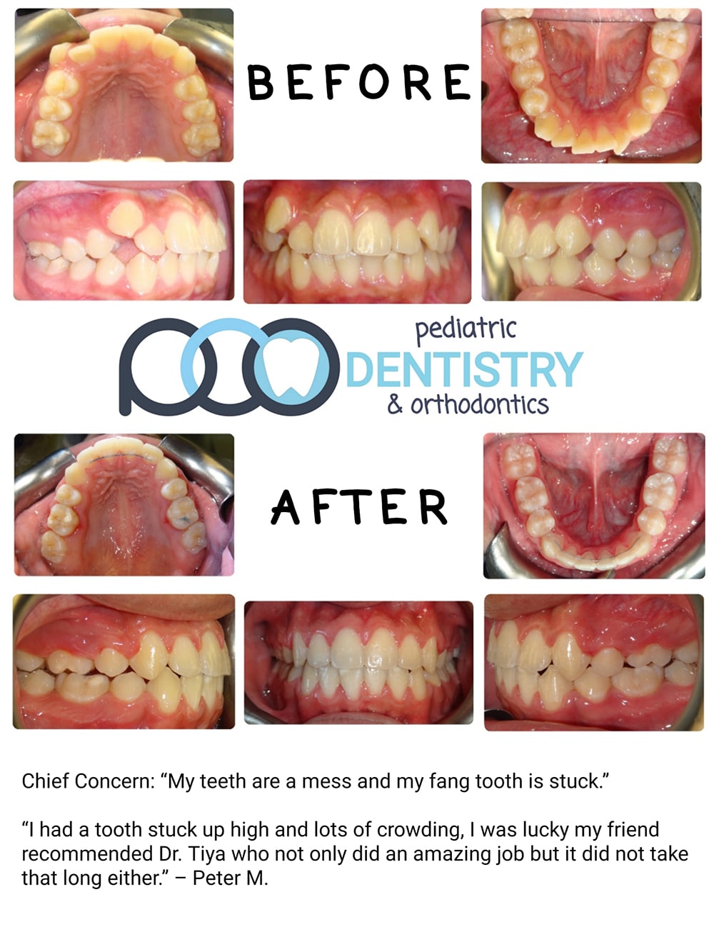 Before and After Fang Tooth