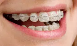 Adult-Braces-In-Queens-Ny.