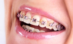Adults-Get-Braces-Too-Pco-Dental