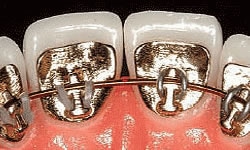 Braces-In-Queens-Ny