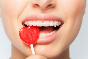 Best Candies You Can Enjoy with Braces in Queens NY!