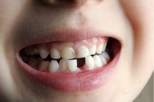 Tooth Extractions for Kids in Queens, NY