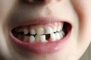 Tips On What To Eat After Tooth Extraction