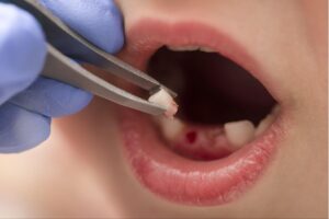 Tooth Extractions for Kids in Queens, NY