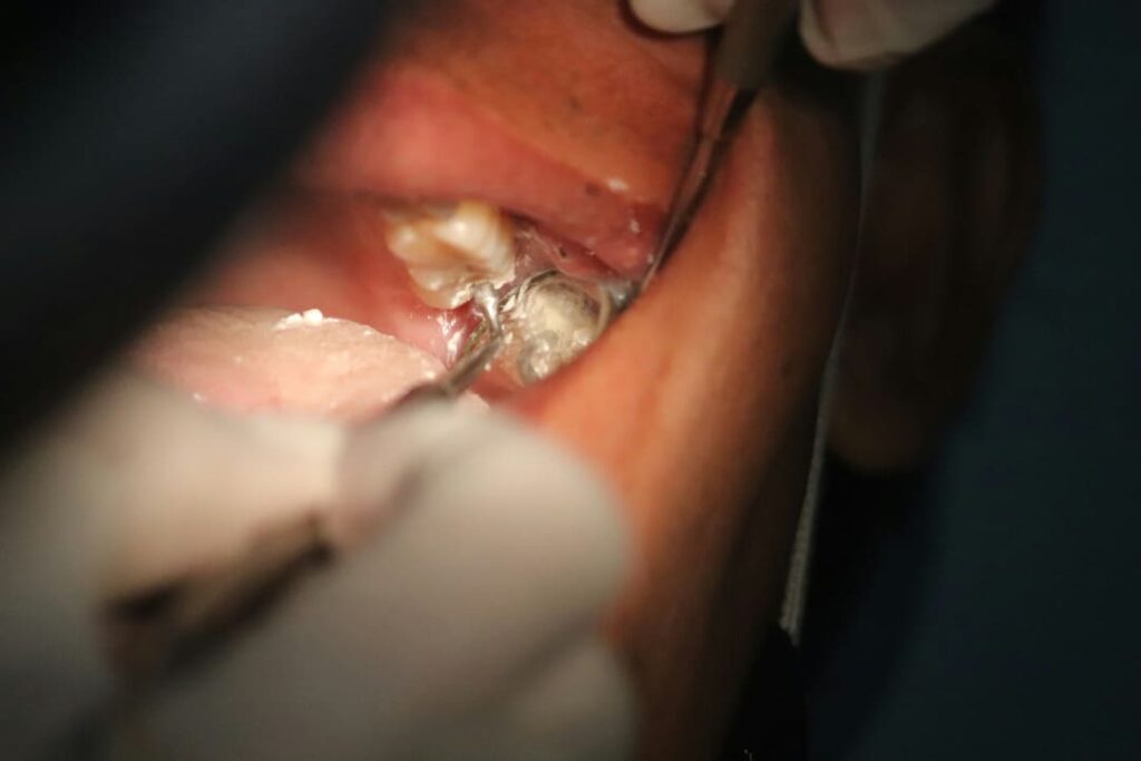 Prevent Cavities