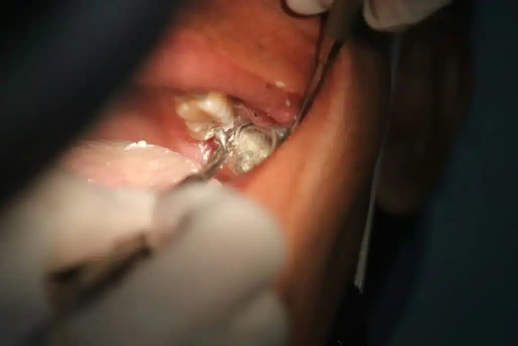 The Hidden Power Of A Dental Cleaning: More Than Just A Bright Smile Dental hygienist performing professional cleaning, removing tartar buildup from patient's teeth, emphasizing preventive care against cavities and promoting oral health.