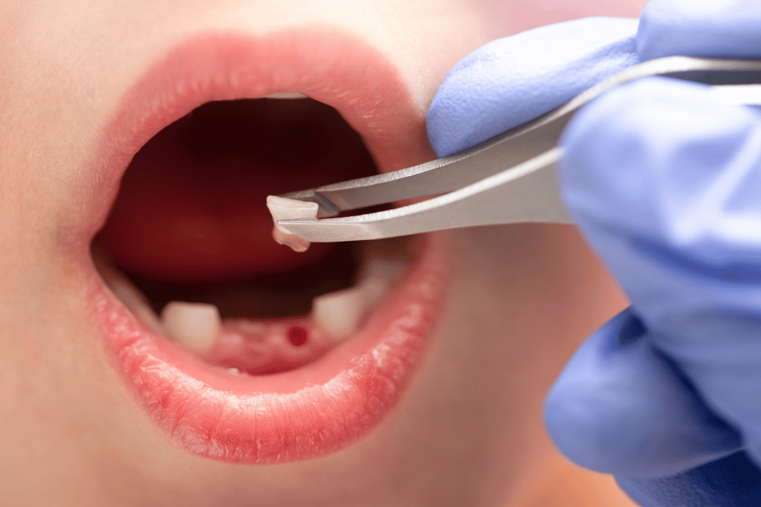 Pediatric Root Canal Vs. Tooth Extraction Pediatric Root Canal Vs. Tooth Extraction