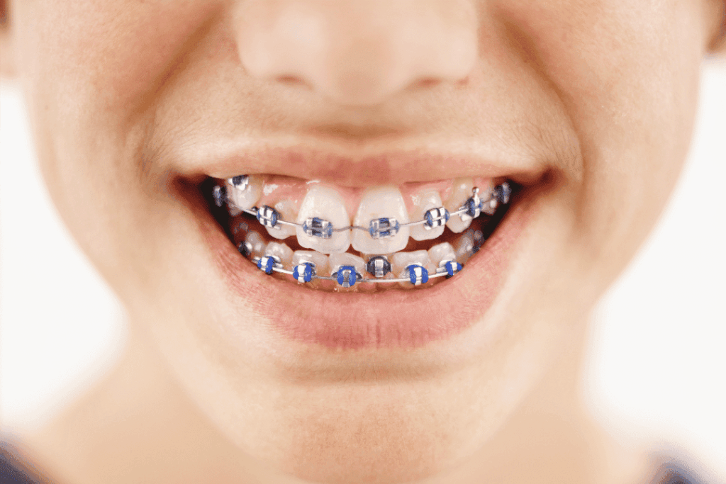 Pediatric Orthodontics For Tooth Alignment