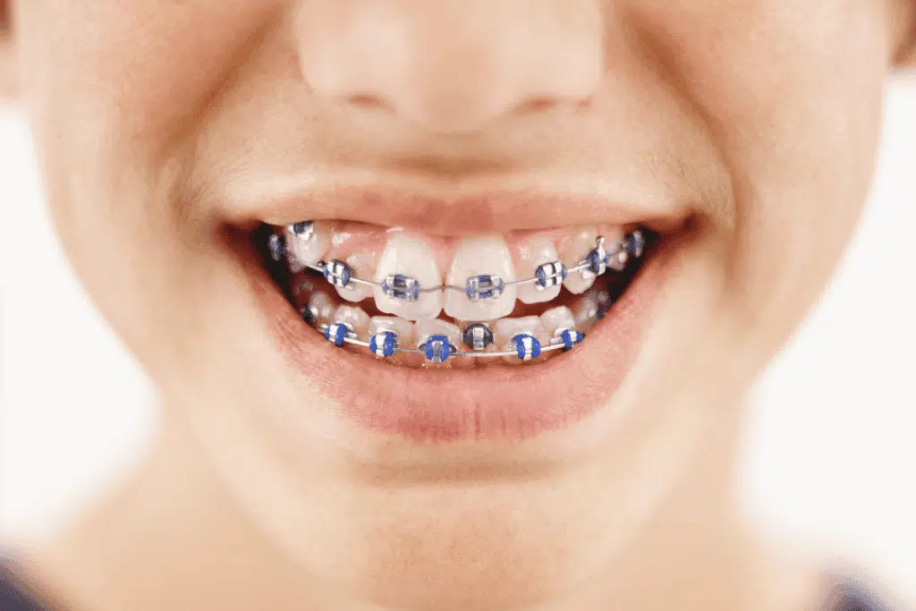 How Do You Know If Your Child Needs An Orthodontic Evaluation? Child smiling with braces, showcasing orthodontic treatment for improved tooth alignment, emphasizing early evaluation benefits in pediatric dentistry.
